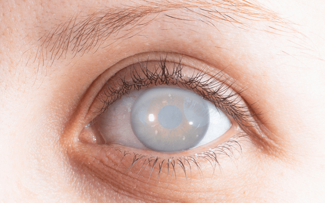 cataract-surgery