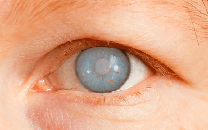 glaucoma-surgery