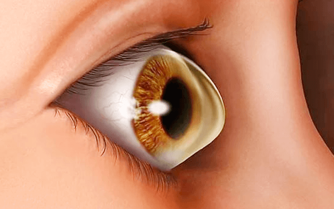 keratoconus
