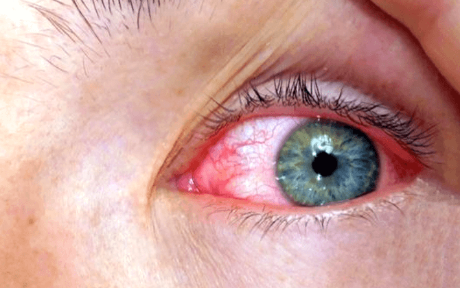 retinal-disease